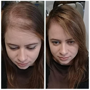 FOLIXIL ANTES E DEPOIS 1