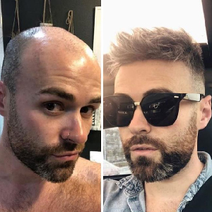 FOLIXIL ANTES E DEPOIS 2