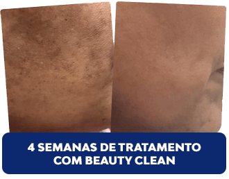 creme clareador de pele antes e depois 3