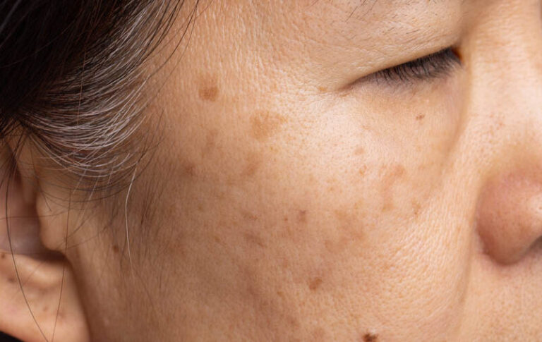 Manchas no Rosto e Melasma: como o Beauty Clean pode ajudar